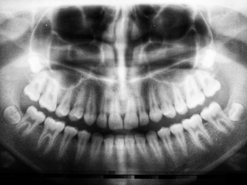 Can Vaping After Tooth Extraction Be Harmful? 2 other vaping ingredients to impact your dental health